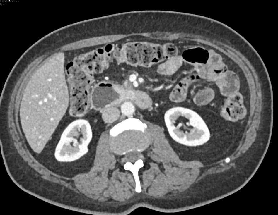 Duodenal Adenocarcinoma - CTisus CT Scan