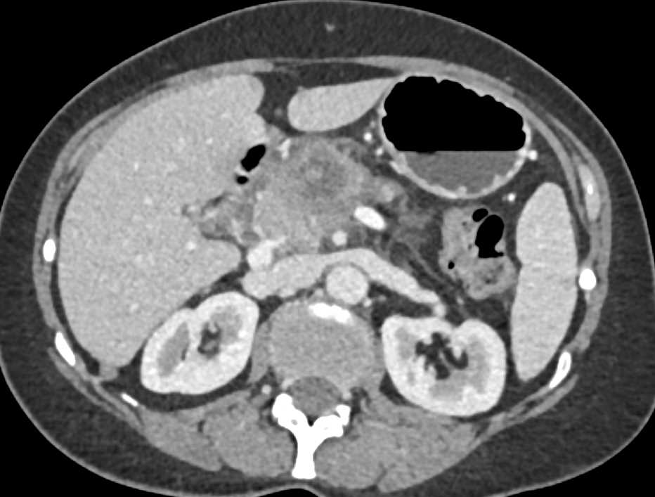 Adenocarcinoma of the Pancreas Encases the PV/SMV Junction - CTisus CT Scan