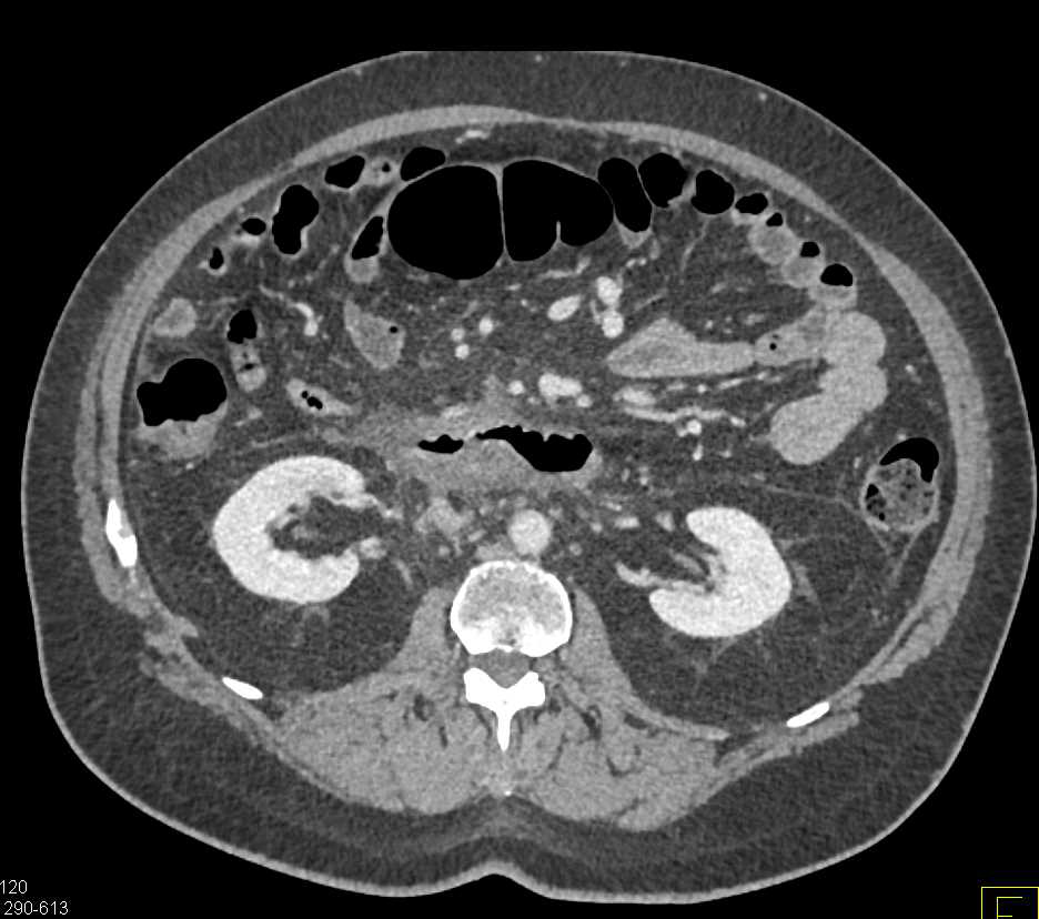 Adenocarcinoma Duodenum - CTisus CT Scan