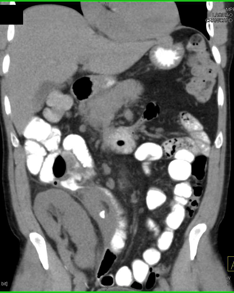 Intramural Hematoma Distal Small Bowel - CTisus CT Scan