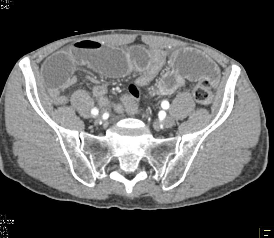 Small Bowel Obstruction (SBO) due to a Right Inguinal Hernia - CTisus CT Scan
