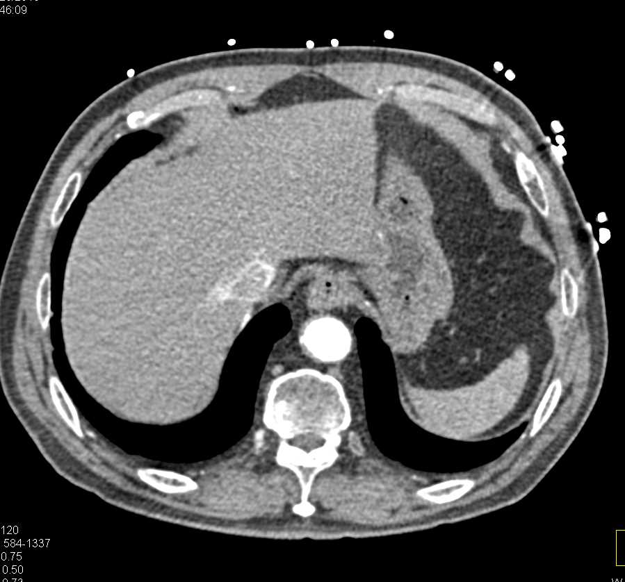 Duodenal Diverticulum - CTisus CT Scan