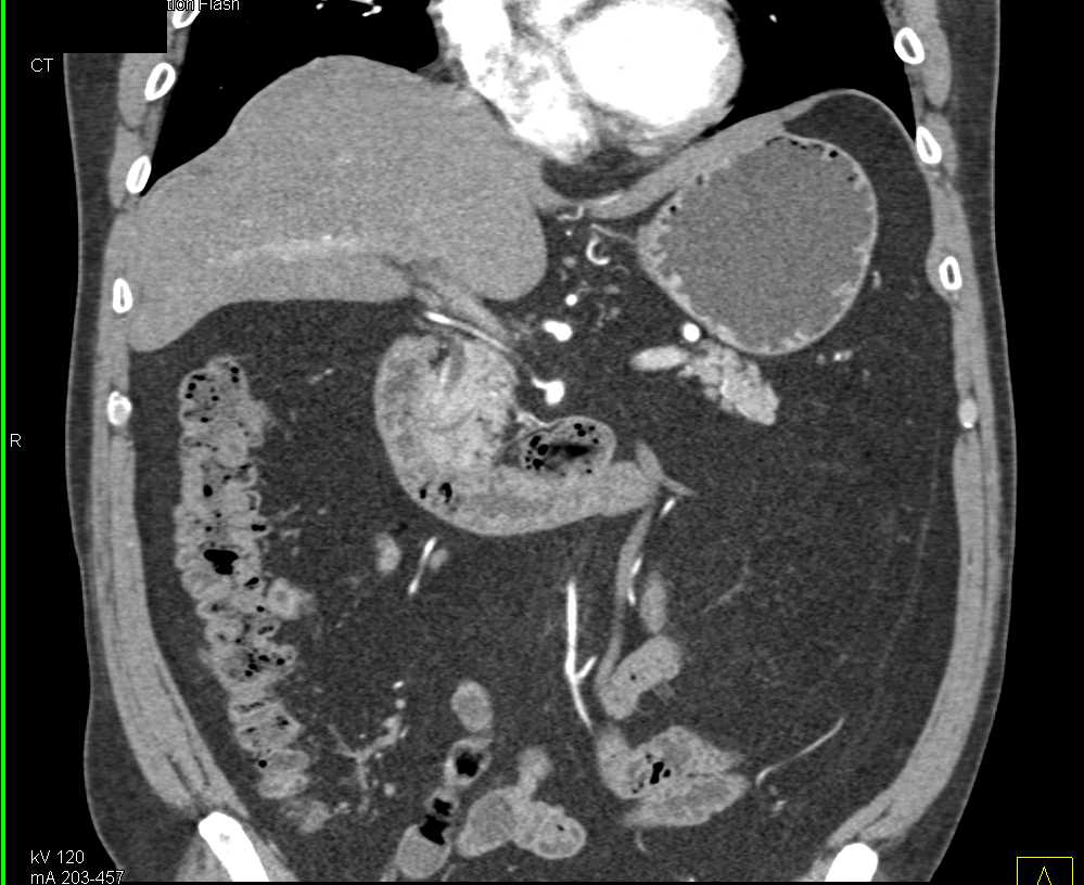 Subtle Adenocarcinoma Duodenum - CTisus CT Scan
