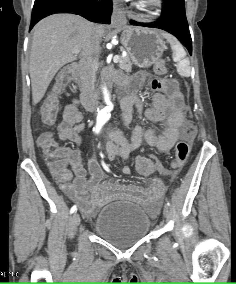 Small Bowel Angioedema as a Complication of ACE Inhibitor Use - CTisus CT Scan