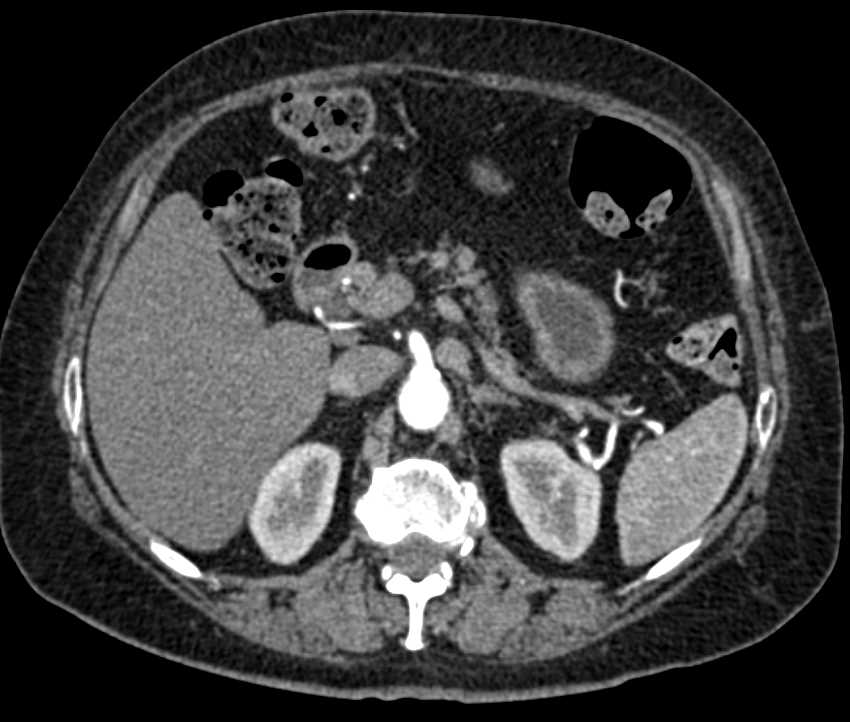 Carcinoid Tumor in the Root of the Mesentery - CTisus CT Scan