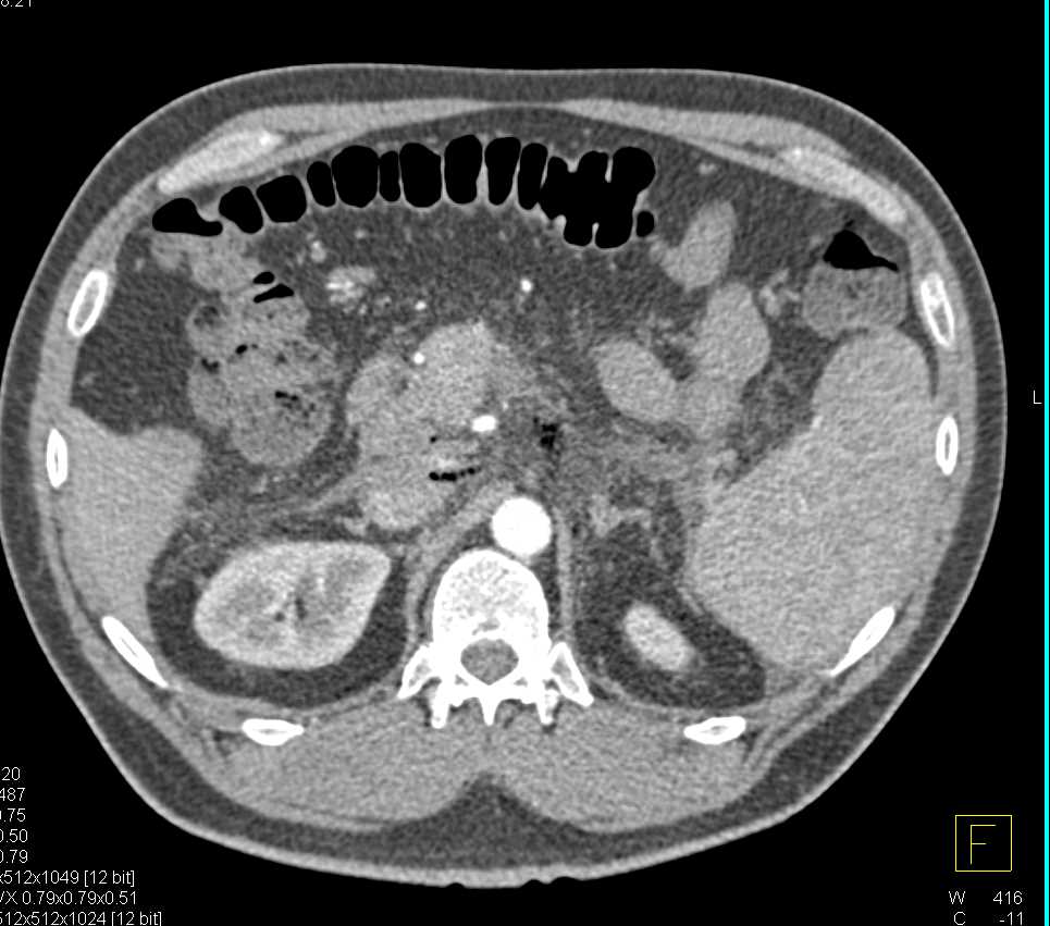 Duodenal Perforation - CTisus CT Scan