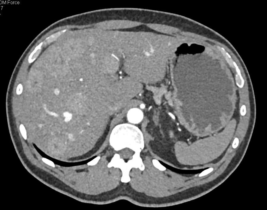 Metastatic Carcinoid Tumor to the Liver - CTisus CT Scan