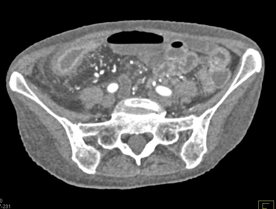 Crohn's Disease Terminal Ileum - CTisus CT Scan