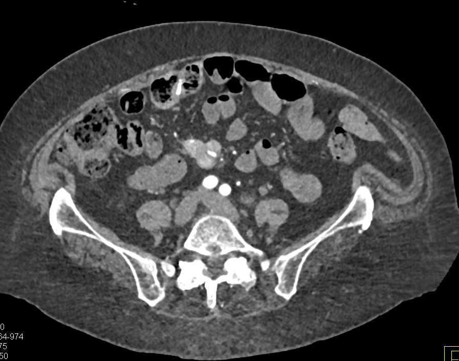 Carcinoid Tumor in the Root of the Mesentery - CTisus CT Scan