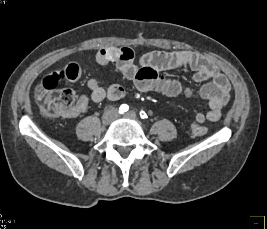 Carcinoid Tumor in the Small Bowel RLQ and Fem-Fem Bypass Graft with Cinematic Rendering - CTisus CT Scan
