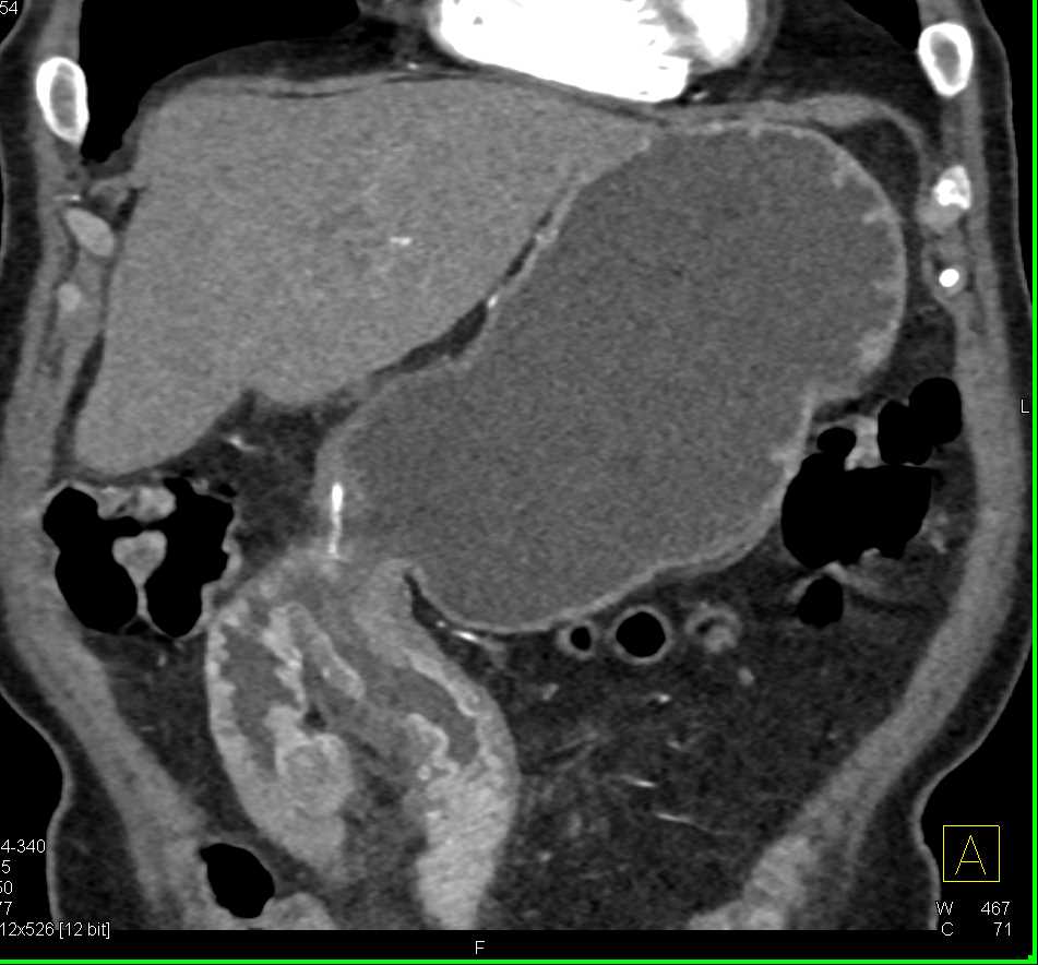 Incidental GIST in Small Bowel in Gastrojejunostomy - CTisus CT Scan