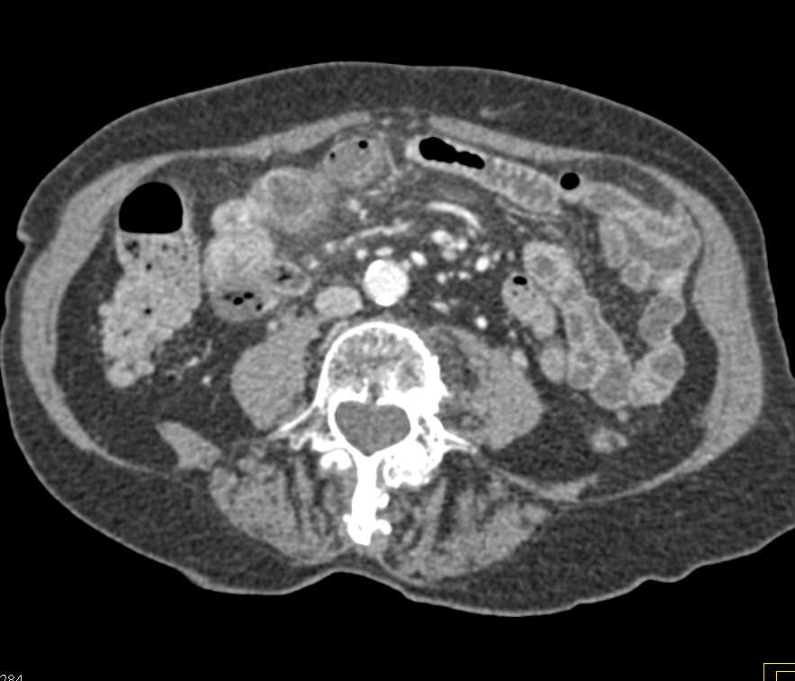 Small Bowel Enteritis - CTisus CT Scan