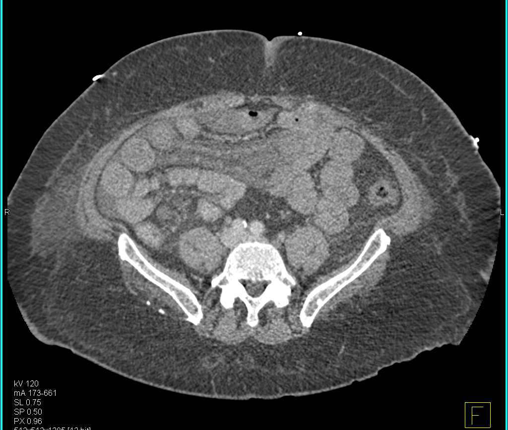Superior Mesenteric Artery (SMA) and Superior Mesenteric Vein (SMV) Clot with Edematous Small Bowel - CTisus CT Scan