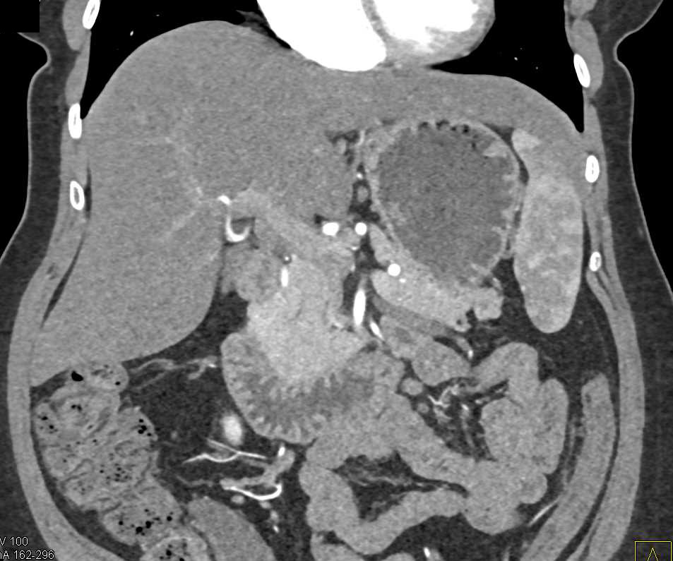 Adenoma of the Ampulla - CTisus CT Scan