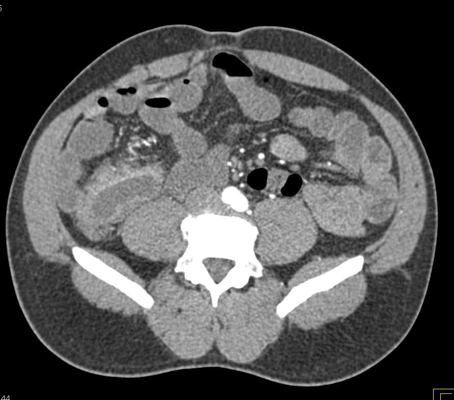 Crohn's Disease Involves the Terminal Ileum - CTisus CT Scan