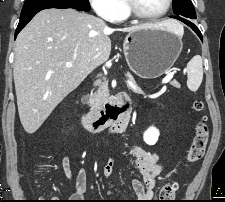Duodenal Adenocarcinoma - CTisus CT Scan
