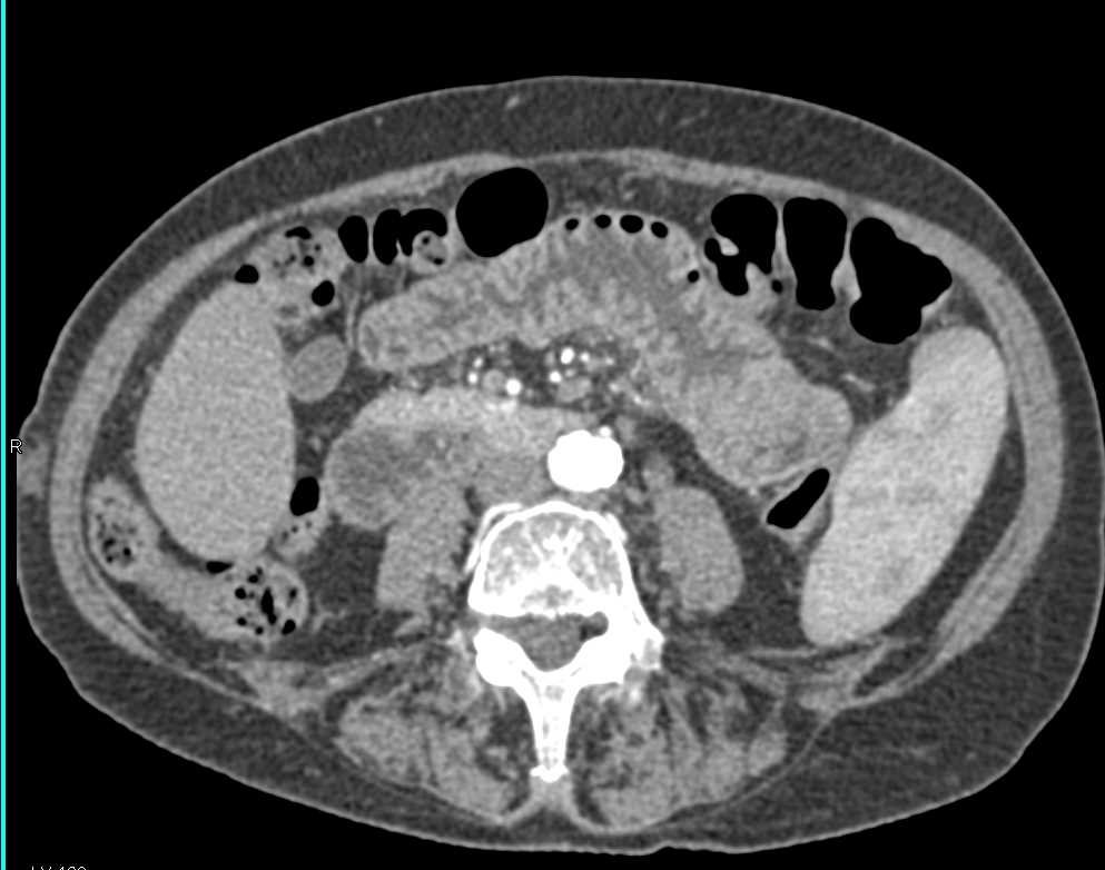 Small Bowel Lipoma - CTisus CT Scan