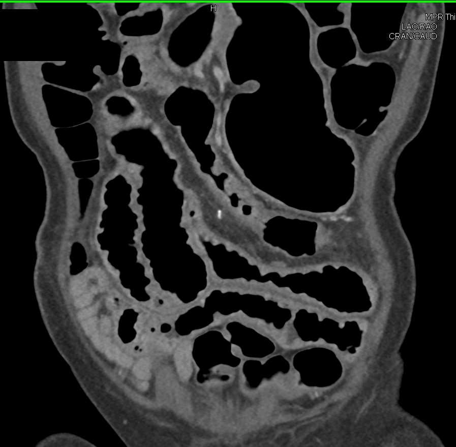 Inflamed Small Bowel - CTisus CT Scan