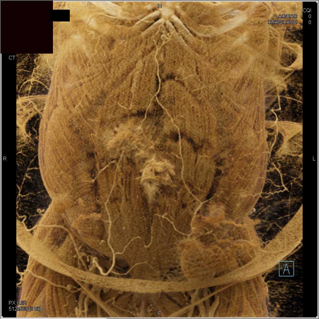 Crohn's Disease and Small Bowel Obstruction - CTisus CT Scan