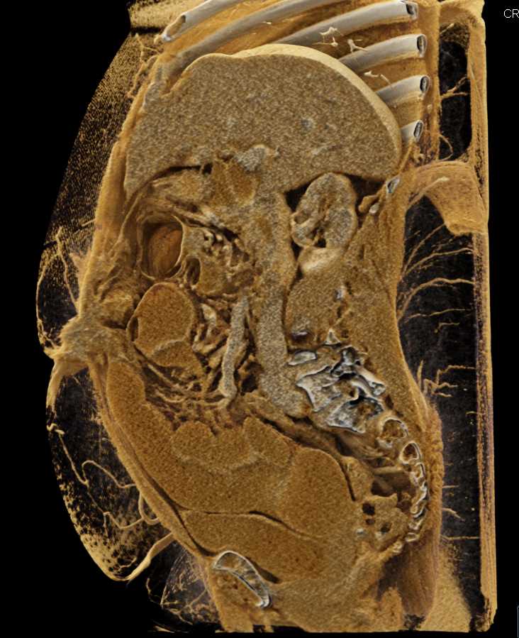Crohn's Disease and Small Bowel Obstruction - CTisus CT Scan