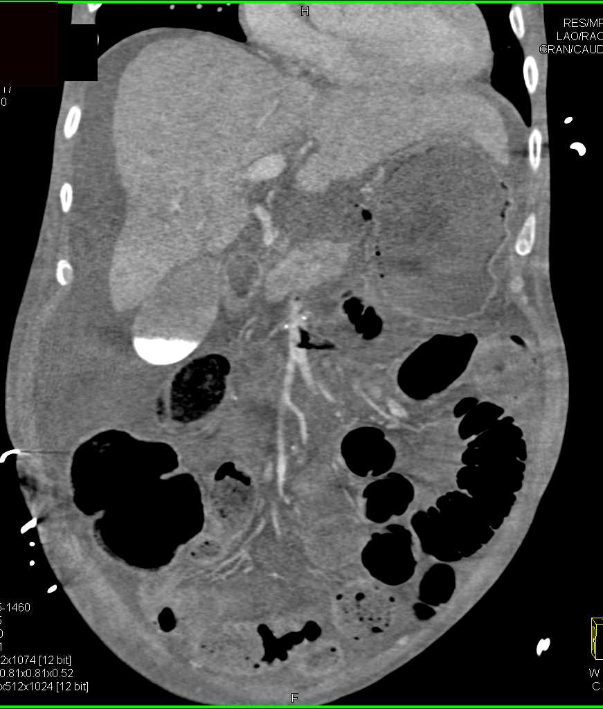 Small Bowel Ischemia - CTisus CT Scan