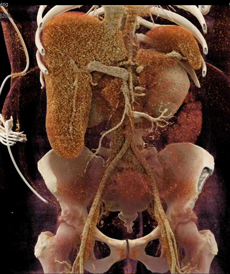 Thickened Small Bowel Pattern - CTisus CT Scan