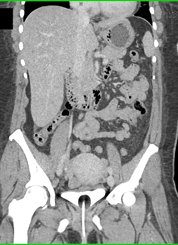 Inflammation of Small Bowel in Left Lower Quadrant - CTisus CT Scan