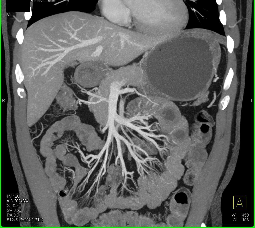 Jejunal Enteritis with Superior Mesenteric Artery (SMA) Arcade - CTisus CT Scan