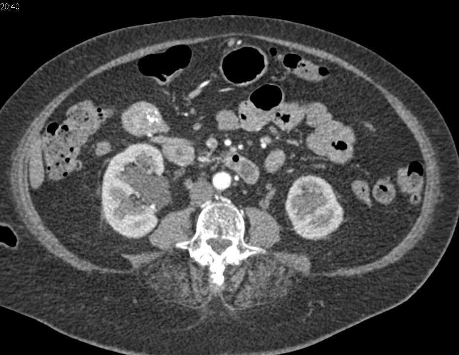 Sclerosing Mesenteritis with Mass in Mesentery - CTisus CT Scan