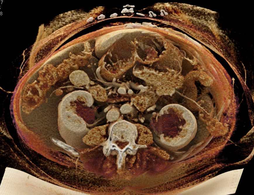 Sclerosing Mesenteritis with Mass in Mesentery - CTisus CT Scan