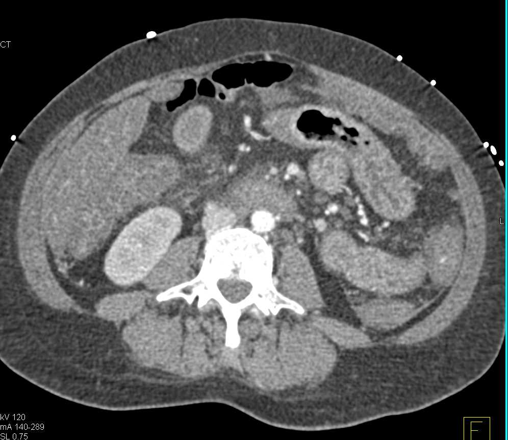 Small Bowel Enteritis with Bleed - CTisus CT Scan