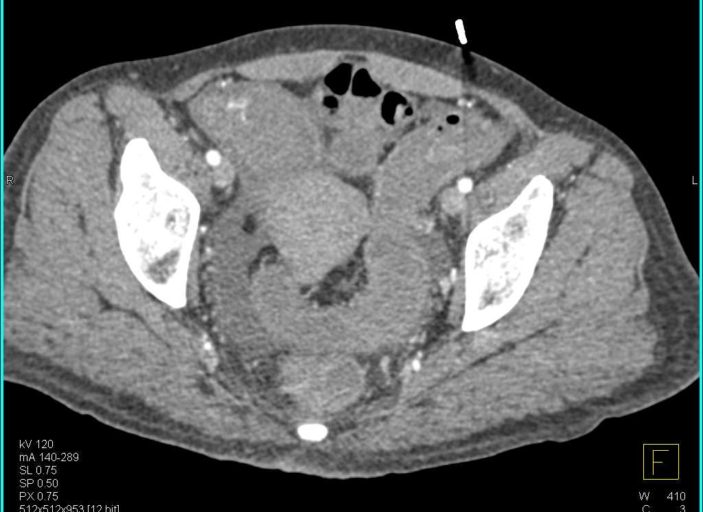 Small Bowel Enteritis with Bleed - CTisus CT Scan