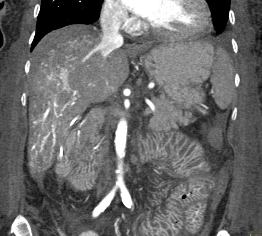 Dilated Small Bowel due to Sprue - CTisus CT Scan