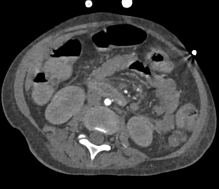 Active Bleed in the Duodenum - CTisus CT Scan