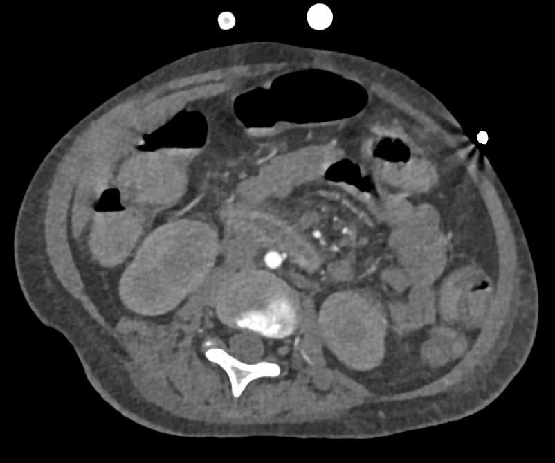 Active Bleed in the Duodenum - CTisus CT Scan