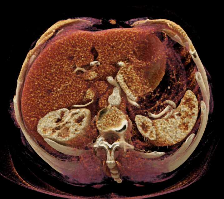 Duodenal GIST Tumor looks like Pancreatic Neuroendocrine Tumor (PNET) - CTisus CT Scan