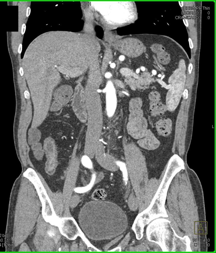 Ischemic Colitis - CTisus CT Scan