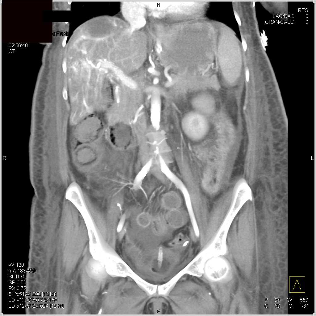 Ischemic Bowel with Pneumatosis - CTisus CT Scan