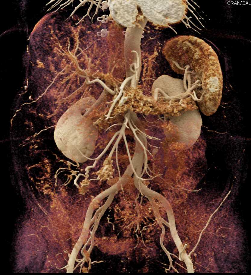 Carcinoid Tumor with Desmoplastic Reaction - CTisus CT Scan