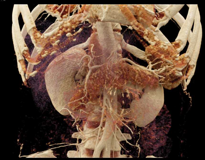 Superior Mesenteric Artery (SMA) Syndrome with Dilated Duodenum - CTisus CT Scan