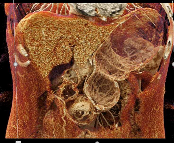 Superior Mesenteric Artery (SMA) Syndrome with Dilated Duodenum - CTisus CT Scan