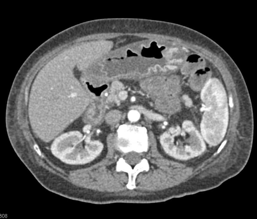 Severe Enteritis Involving the Small Bowel due to Graft vs Host Disease - CTisus CT Scan