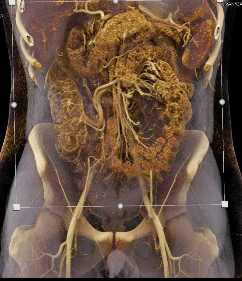 Cinematic Rendering of the Bowel - CTisus CT Scan