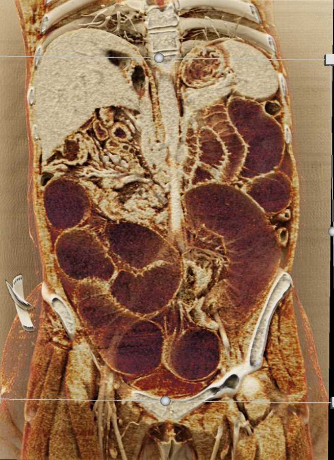 Small Bowel Obstruction with Cinematic Rendering - CTisus CT Scan