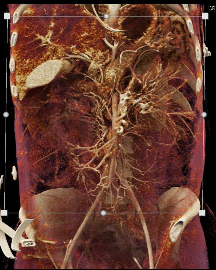 Small Bowel Obstruction with Cinematic Rendering - CTisus CT Scan