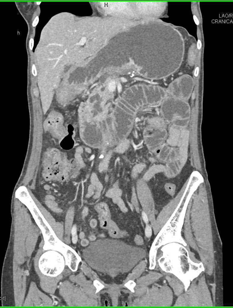 Adenocarcinoma of the Small Bowel Causing Obstruction - CTisus CT Scan