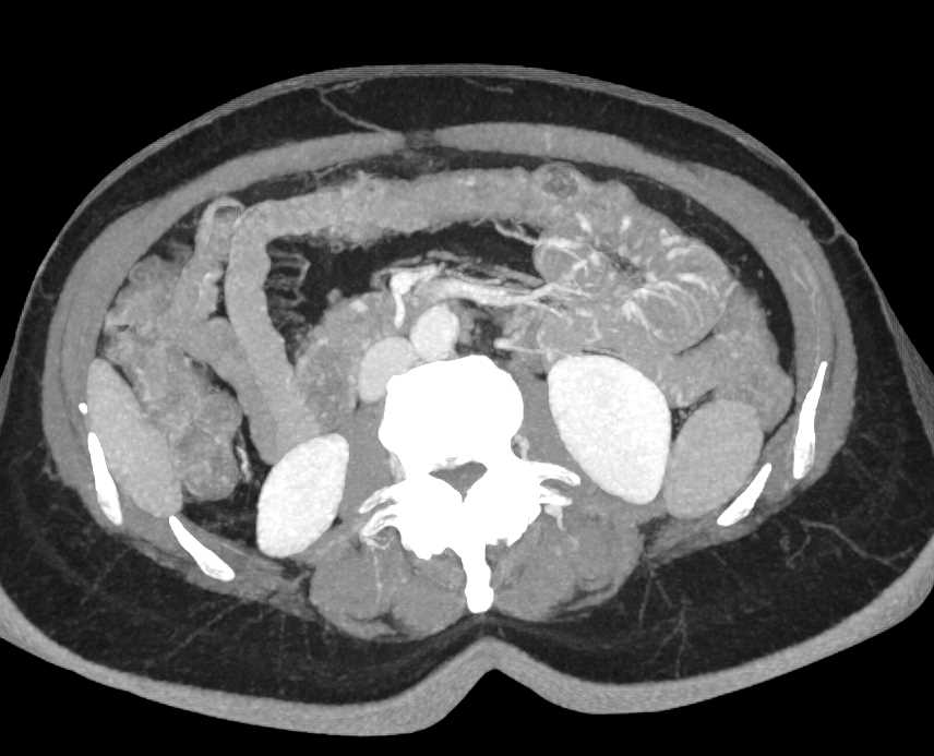 Angiodysplasia Proximal Small Bowel - CTisus CT Scan