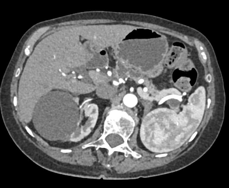Duodenal Lipoma - CTisus CT Scan