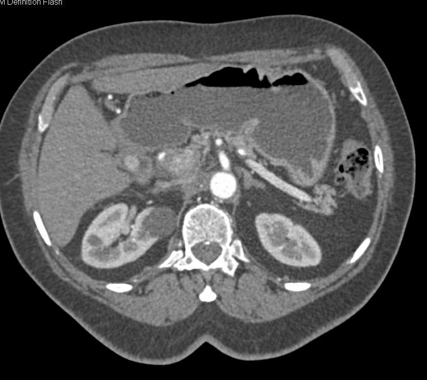 1cm Carcinoid Tumor Duodenum - CTisus CT Scan