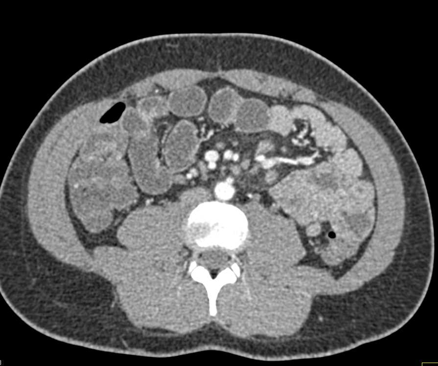 Mesenteric Nodes due to Mycobacterium avium/intracellulare (MAI) Infection - CTisus CT Scan